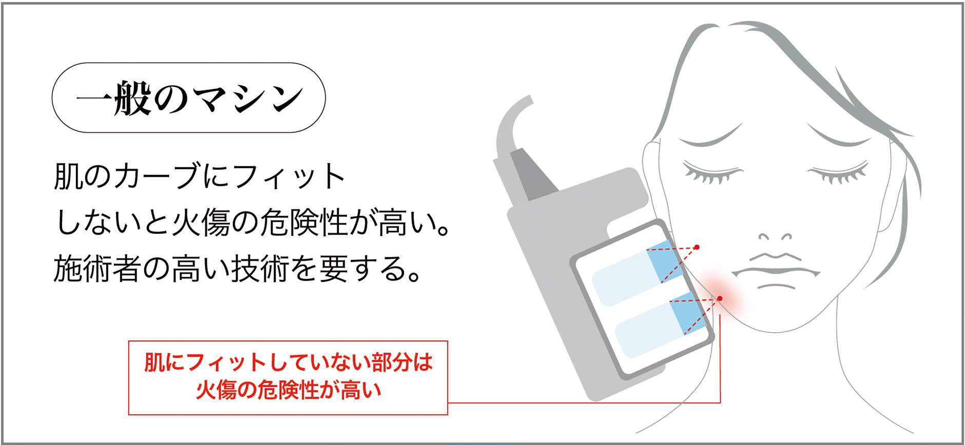 一般のハイフの構造